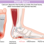 درد پاشنه پا نشانه چیست و چگونه از آن پیشگیری کنیم؟